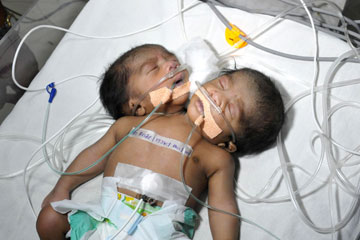 Inde: naissance d'un b&eacute;b&eacute; &agrave; deux t&ecirc;tes